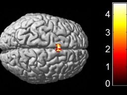 Bahnbrechende Erkenntnisse zu Bewegungsstörungen bei Psychosen